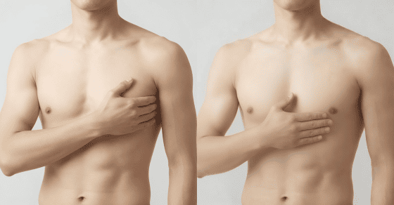 男 スペンス乳腺